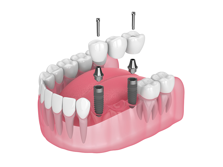 Everything to Know About Dental Bridges