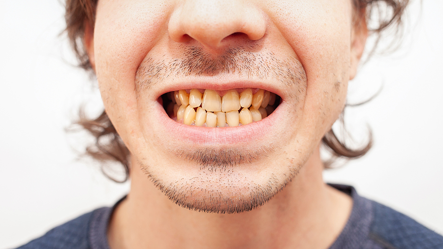 Is Zoom Teeth Whitening a Quick Cosmetic Fix?