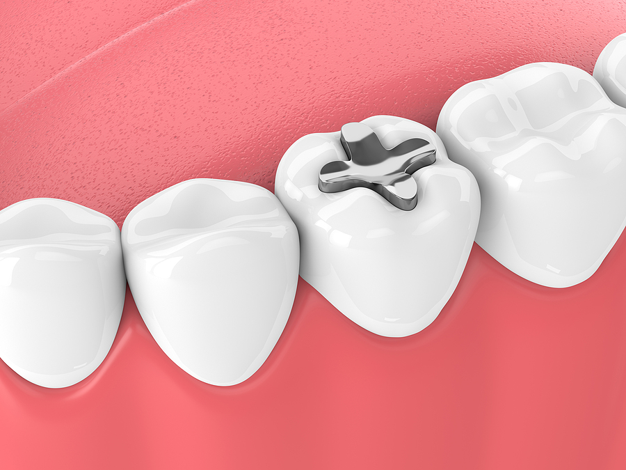 Everything You Need to Know About Dental Fillings in Englishtown, NJ