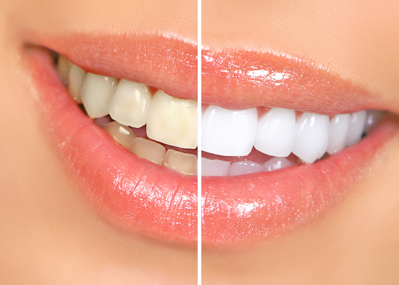 Brighten Your Smile with Zoom Teeth Whitening in Englishtown, NJ